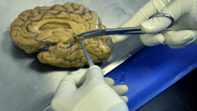 Estudio advierte que prometedora terapia contra el Alzheimer provocaría una reducción en el tamaño del cerebro