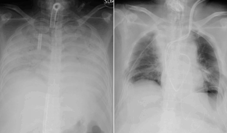 Médicos realizan el primer trasplante de pulmón de donantes vivos a paciente con daños por COVID-19