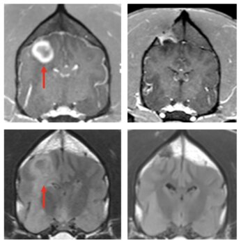 Crean un posible tratamiento viable para combatir el cáncer cerebral