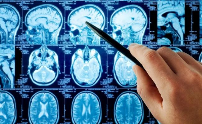 Estudio: El COVID-19 puede causar inflamación y pequeñas hemorragias cerebrales en primates