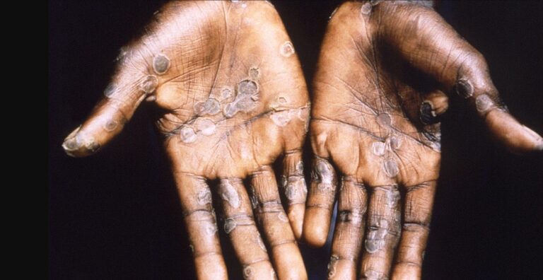 Estudio en Reino Unido detectó diferentes síntomas en la viruela del mono