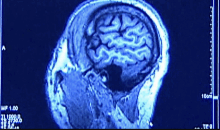 Niebla mental, el síntoma que afecta a los pacientes sobrevivientes del COVID-19