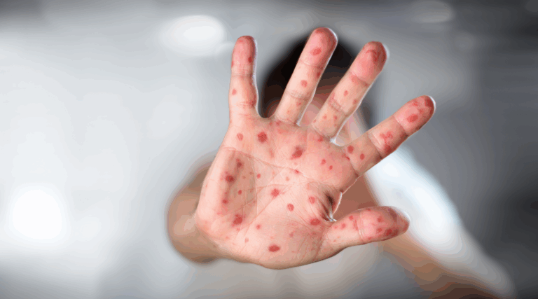 Arabia Saudita detectó el primer caso de viruela del mono en su territorio