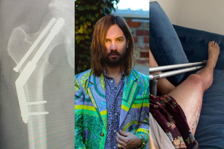 ¿Otra baja en Lollapalooza Chile? Kevin Parker de Tame Impala se fracturó la cadera a días del show