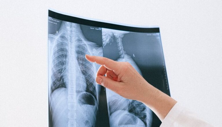 Cáncer de pulmón en Chile: ¿Cómo se diagnostica y cuáles son sus síntomas?