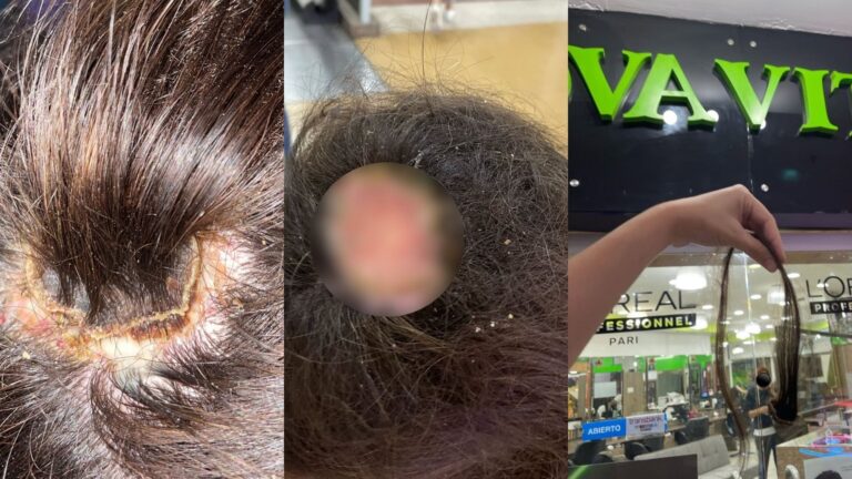 Joven sufrió quemaduras de tercer grado en la cabeza tras procedimiento en peluquería de Quilpué