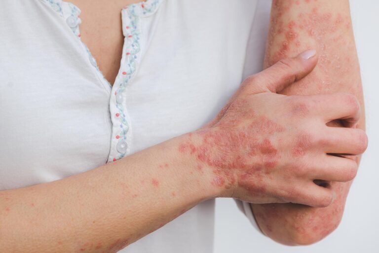 Psoriasis: ¿Qué la causa y cuáles son sus síntomas?